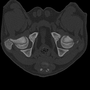 Im CT werden Veränderungen des Hüftgelenks sichtbar.